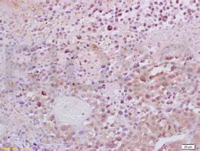 复发ALL患者希望接受CRA-T细胞治疗