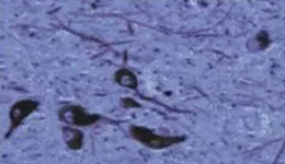 正常人：黑质神经元存在