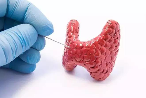 甲状腺疾。鬃聪俟δ芗跬撕图鬃聪俟δ芸航，自古以来就是反复被医学研究人员研究的疾病