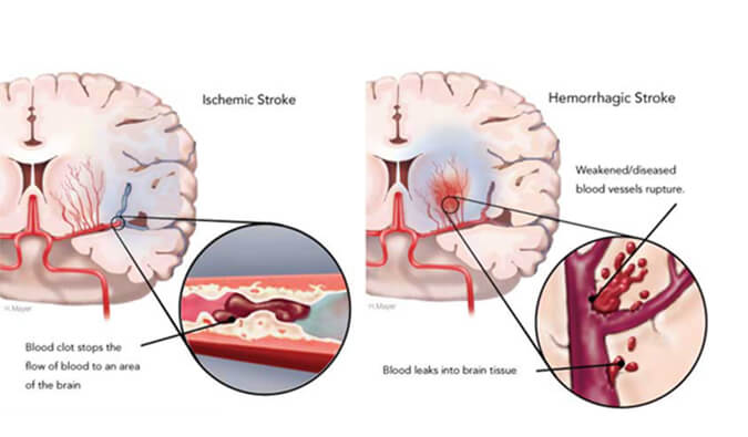 世界卒中日：从动物药效模型评价看心脑血管药物开发